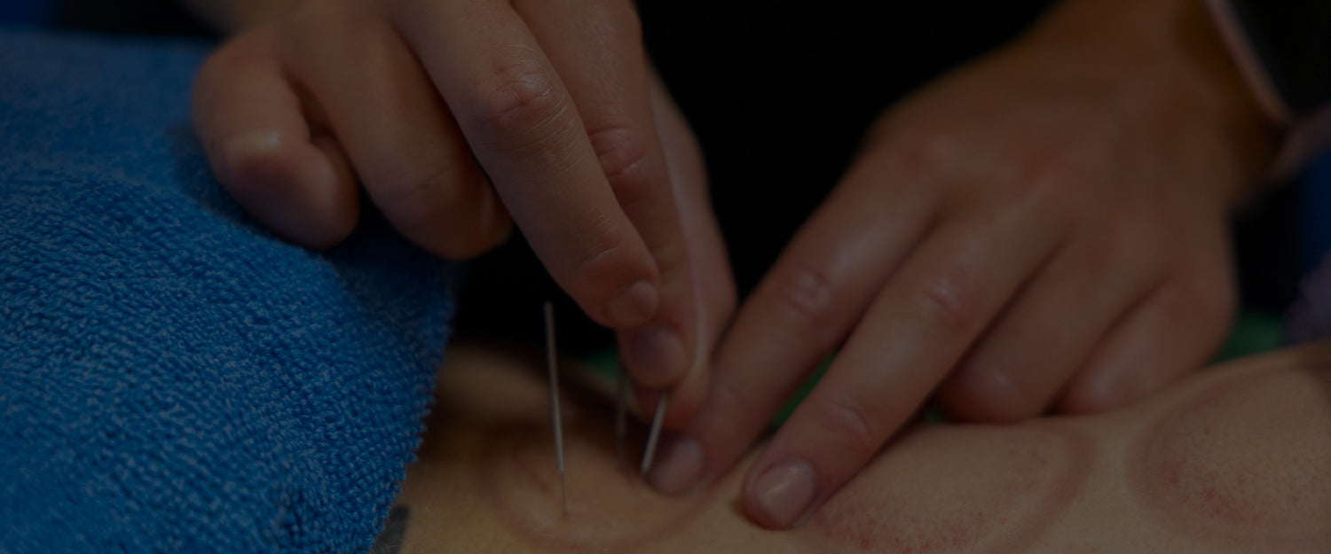 Physio putting in 3 metal pins into skin in electro-acupuncture session. 